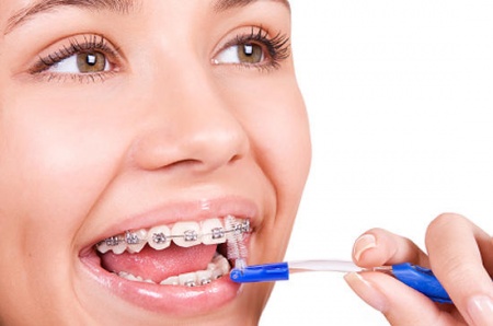 5 видов продуктов, от которых надо отказаться в период лечения зубочелюстного аппарата. Советы стоматологии на Позняках «Вива-Дент»