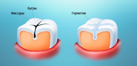 Врачи стоматологической клиники на Позняках (Киев) «Вива-Дент» рекомендуют герметизацию фиссур как профилактику кариеса у детей