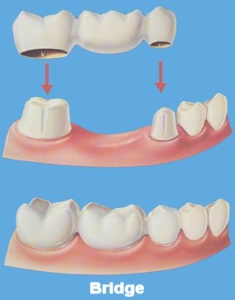 «Выбор метода протезирования зубов определяется возрастом пациента», – убеждены стоматологи клиники на Позняках (Киев) «Вива-Дент»